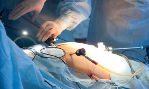 Laparoscopy at Paarasmani Hospital Pune, Hadpsar