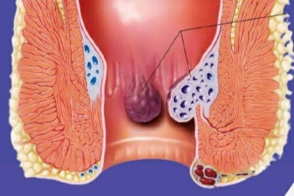 Laparoscopy at Paarasmani Hospital Pune, Hadpsar