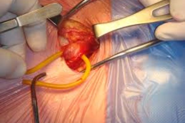 Laparoscopy at Paarasmani Hospital Pune, Hadpsar